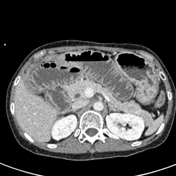 Adhesional small bowel obstruction (Radiopaedia 48397-53305 Axial C+ portal venous phase 20).jpg