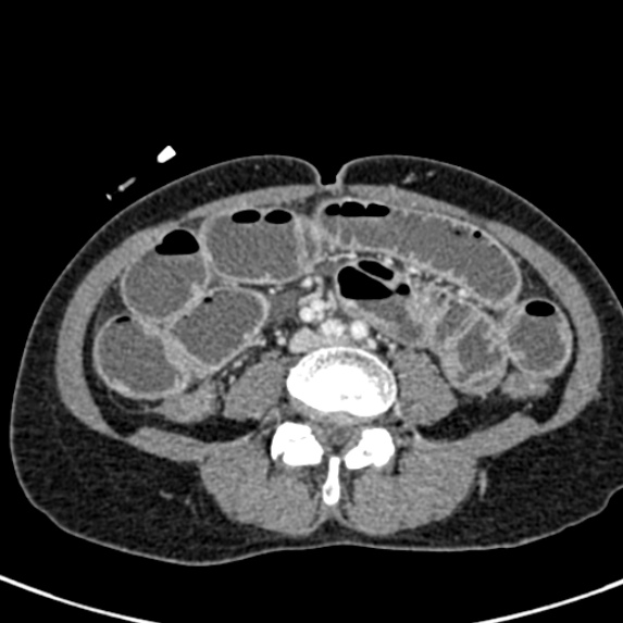 Adhesional small bowel obstruction (Radiopaedia 48397-53305 Axial C+ portal venous phase 53).jpg