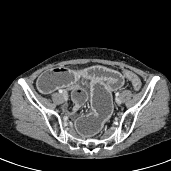File:Adhesional small bowel obstruction (Radiopaedia 48397-53305 Axial C+ portal venous phase 73).jpg