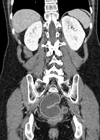 Adhesional small bowel obstruction (Radiopaedia 48397-53305 Coronal C+ portal venous phase 264).jpg