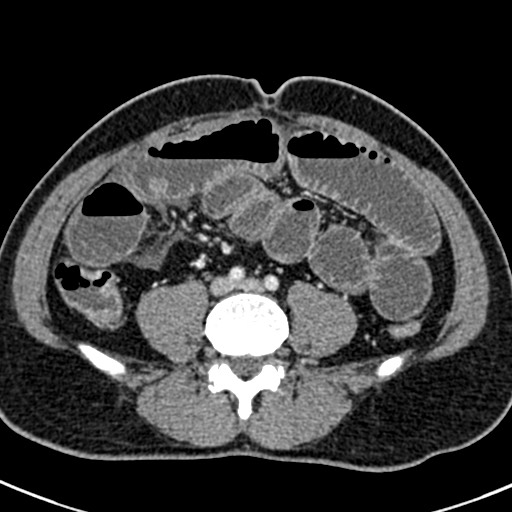 Adhesional small bowel obstruction (Radiopaedia 58900-66131 Axial C+ portal venous phase 33).jpg