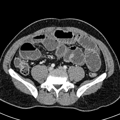 File:Adhesional small bowel obstruction (Radiopaedia 58900-66131 Axial C+ portal venous phase 35).jpg