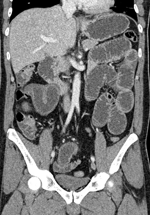 Adhesional small bowel obstruction (Radiopaedia 58900-66131 Coronal C+ portal venous phase 137).jpg