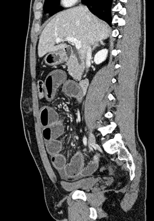 Adhesional small bowel obstruction (Radiopaedia 58900-66131 Sagittal C+ portal venous phase 102).jpg