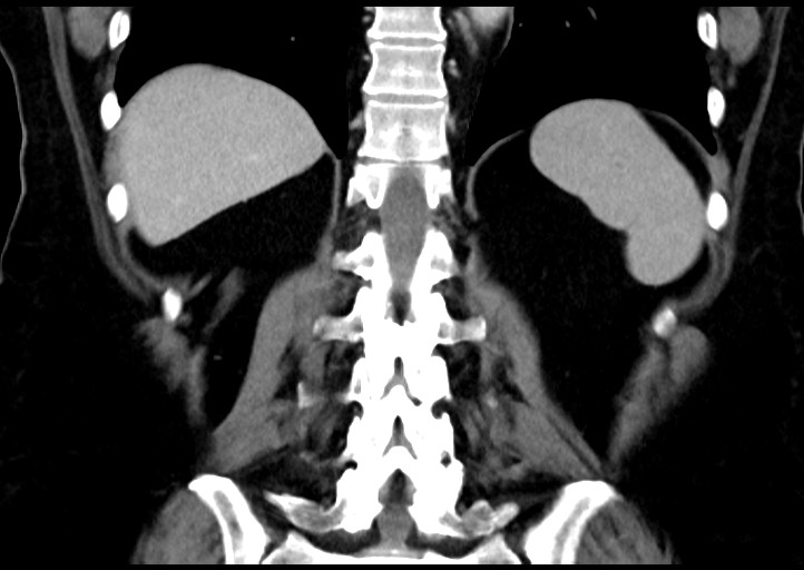 Adrenal cortical carcinoma (Radiopaedia 64017-72769 Coronal C+ portal venous phase 41).jpg