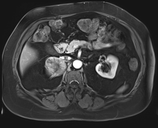 Adrenal cortical carcinoma (Radiopaedia 64017-72770 I 38).jpg