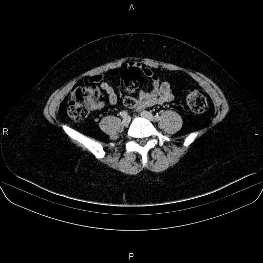 Adrenal cortical carcinoma (Radiopaedia 84882-100379 Axial C+ delayed 63).jpg