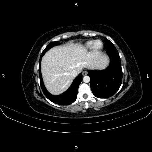 Adrenal cortical carcinoma (Radiopaedia 84882-100379 Axial C+ portal venous phase 10).jpg