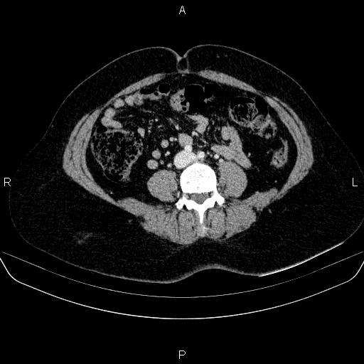 Adrenal cortical carcinoma (Radiopaedia 84882-100379 Axial C+ portal venous phase 55).jpg