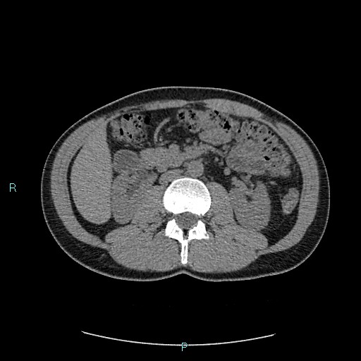 Adrenal cystic lymphangioma (Radiopaedia 83161-97534 Axial non-contrast 43).jpg