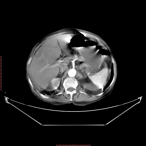 Adrenal hemangioma (Radiopaedia 68923-78668 Axial C+ arterial phase 26).jpg