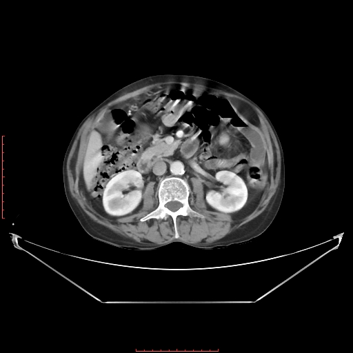Adrenal hemangioma (Radiopaedia 68923-78668 Axial C+ portal venous phase 34).jpg
