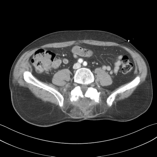Adrenal hematoma (Radiopaedia 44334-47968 Axial C+ portal venous phase 51).png