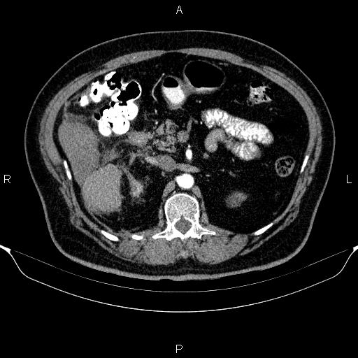 File:Adrenal hemorrhage (Radiopaedia 62622-70916 Axial C+ arterial phase 145).jpg