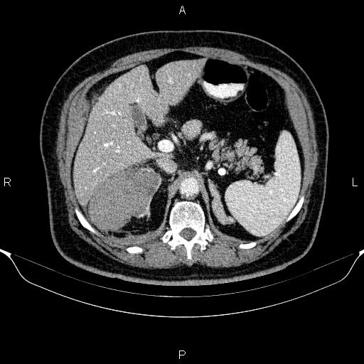 Adrenal hemorrhage (Radiopaedia 62622-70916 Axial C+ portal venous phase 53).jpg