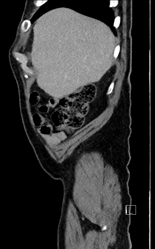 Adrenal lymphoma (Radiopaedia 73730-84529 Sagittal C+ portal venous phase 13).jpg