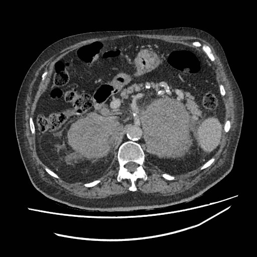 Adrenal lymphoma (Radiopaedia 84145-99415 Axial C+ portal venous phase 35).jpg