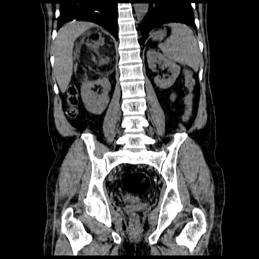File:Adrenal myelolipoma (Radiopaedia 41843-44834 Coronal non-contrast 13).jpg