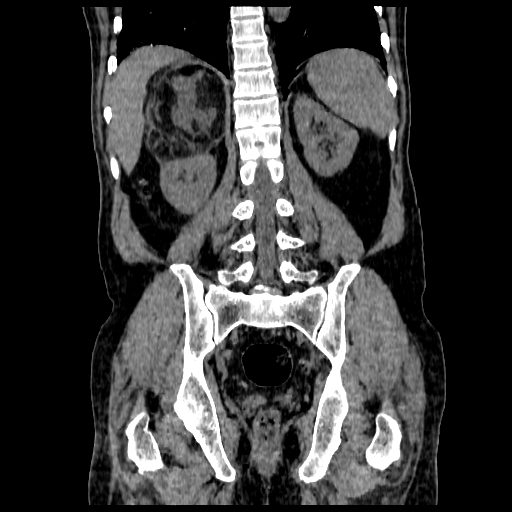 File:Adrenal myelolipoma (Radiopaedia 41843-44834 Coronal non-contrast 15).jpg