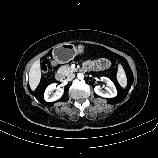 File:Adrenal myelolipoma (Radiopaedia 82742-96986 Axial renal cortical phase 74).jpg