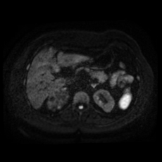 File:Adrenal myelolipoma - MRI (Radiopaedia 83249-97646 Axial DWI 12).jpg