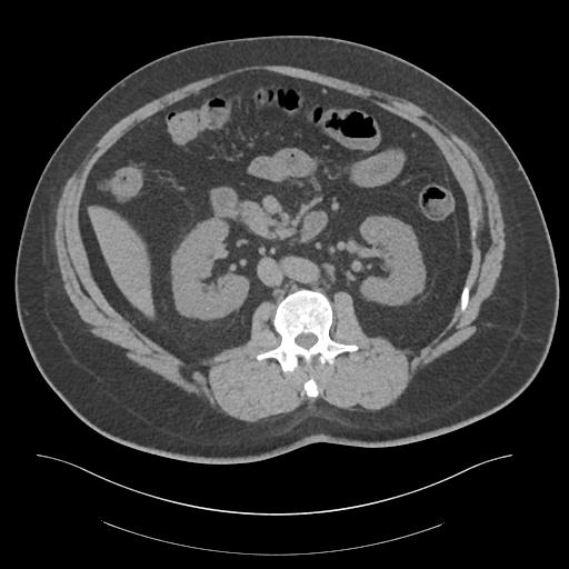 File:Adrenal vein sampling and adrenal nodular hyperplasia - Conn syndrome (Radiopaedia 30561-31337 Axial non-contrast 39).jpg