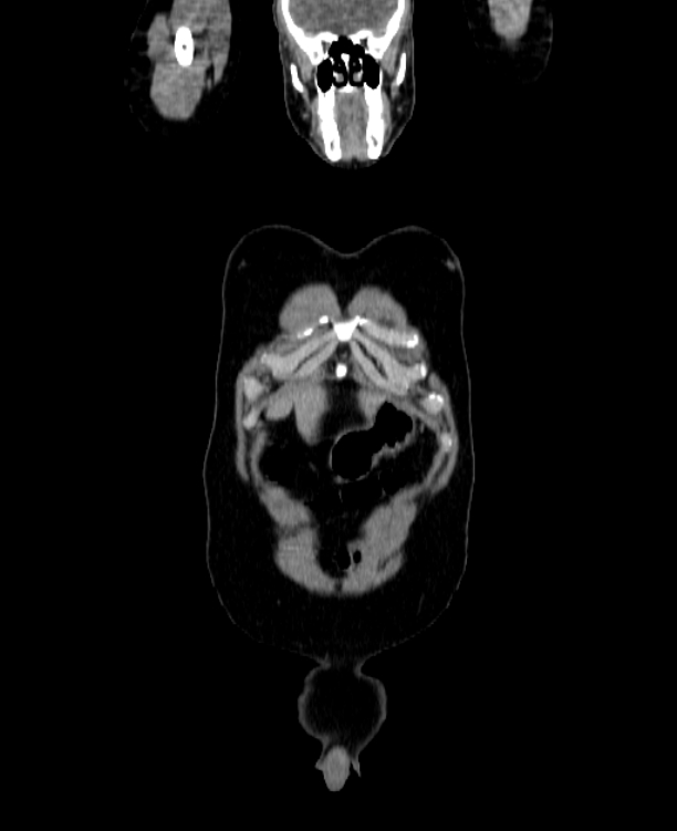 Adrenocortical carcinoma (Radiopaedia 80134-93438 Coronal C+ portal venous phase 20).jpg