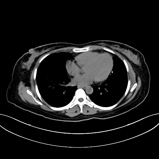 Adrenocortical carcinoma (Radiopaedia 87281-103569 Axial non-contrast 5).jpg