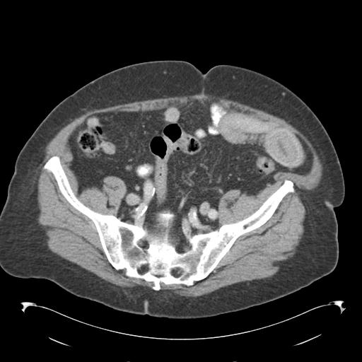 Adult ileal intussusception with secondary obstruction (Radiopaedia 30395-31051 Axial C+ portal venous phase 60).jpg