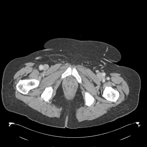 Adult ileal intussusception with secondary obstruction (Radiopaedia 30395-31051 Axial C+ portal venous phase 81).jpg