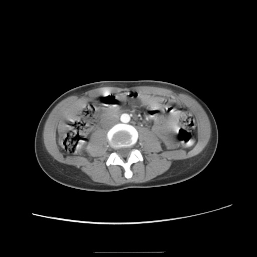 Adult polycystic kidney disease (Radiopaedia 48845-53876 Axial renal cortical phase 38).jpg