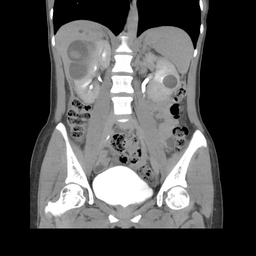 File:Adult polycystic kidney disease (Radiopaedia 48845-53876 Coronal renal excretory phase 23).jpg