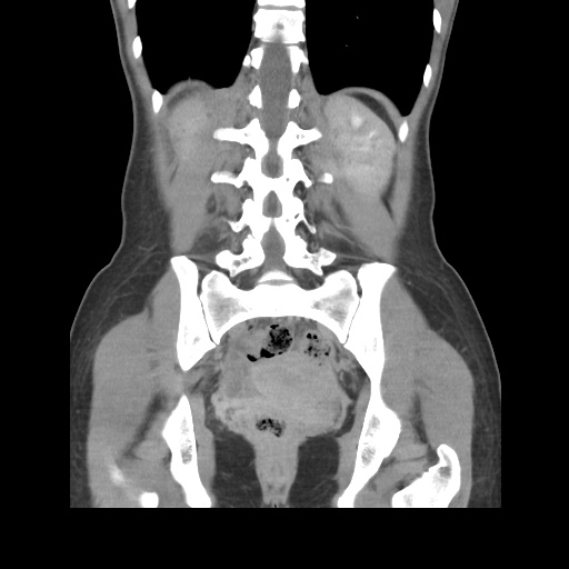 File:Adult polycystic kidney disease (Radiopaedia 48845-53876 Coronal renal excretory phase 32).jpg