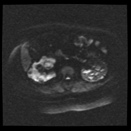 Adult polycystic kidney disease (Radiopaedia 59075-66365 Axial DWI 47).jpg