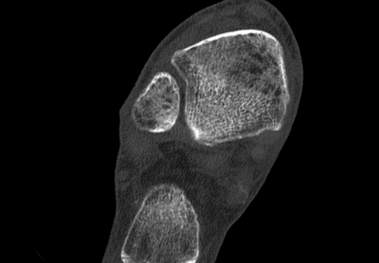 Advanced osteomyelitis due to open metatarsal fracture (Radiopaedia 83891-99095 Axial bone window 1).jpg