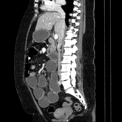 Afferent loop syndrome - secondary to incarcerated trocar site hernia (Radiopaedia 82959-97305 Sagittal C+ portal venous phase 85).jpg