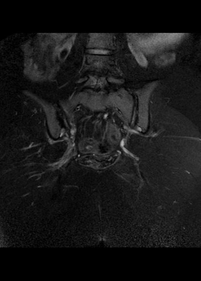 File:Aggressive angiomyxoma of the pelvis and perineum (Radiopaedia 59162-66479 Coronal T2 fat sat 22).jpg