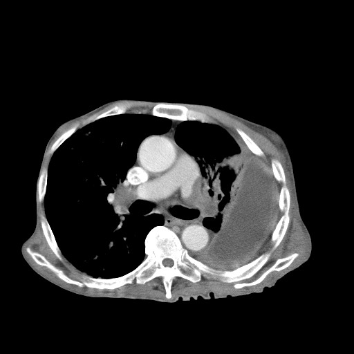 File:Aggressive lung cancer with cardiac metastases, pulmonary artery tumor thrombus, and Budd-Chiari (Radiopaedia 60320-67981 A 26).jpg