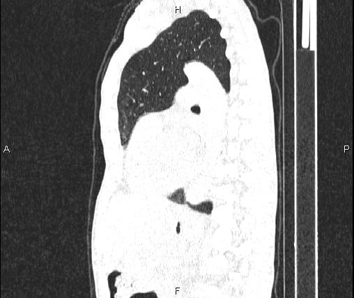 File:Air bronchogram in pneumonia (Radiopaedia 85719-101512 Sagittal lung window 60).jpg