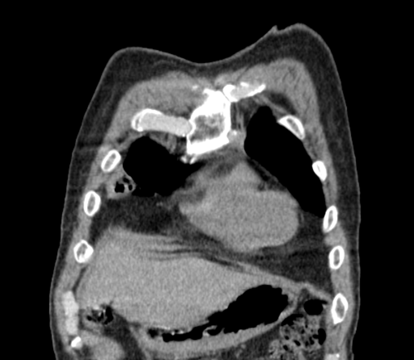 Airway foreign body in adult (Radiopaedia 85907-101779 Coronal liver window 29).jpg