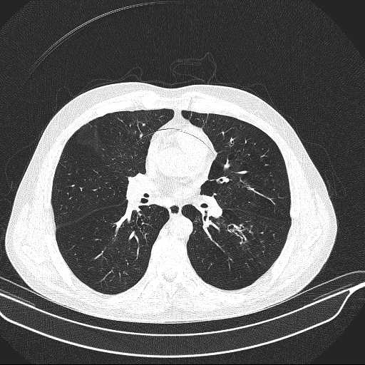 File:Allergic bronchopulmonary aspergillosis (Radiopaedia 21386-21320 Axial lung window 19).jpg