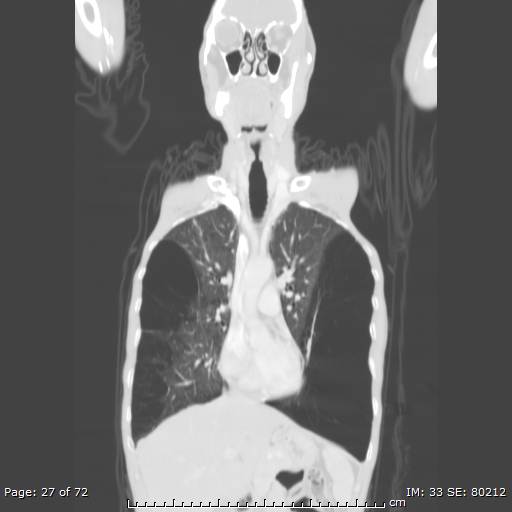 File:Alpha-1-antitrypsin deficiency (Radiopaedia 50561-55987 Coronal lung window 25).jpg
