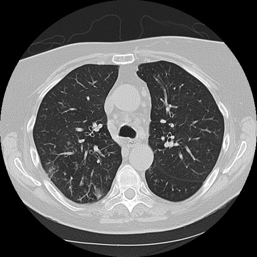 Alpha-1-antitrypsin deficiency (Radiopaedia 72058-82557 Axial lung window 25).jpg