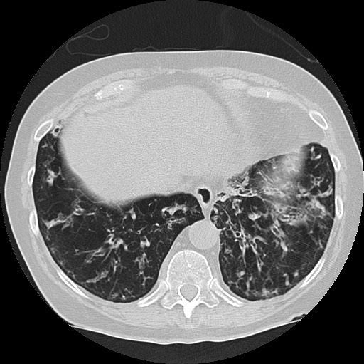 Alpha-1-antitrypsin deficiency (Radiopaedia 72058-82557 Axial lung window 58).jpg