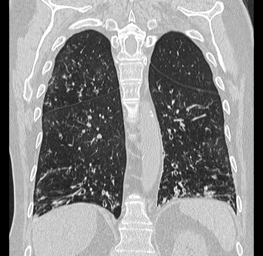 Alpha-1-antitrypsin deficiency (Radiopaedia 72058-82557 Coronal lung window 71).jpg