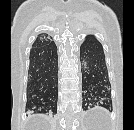 Alpha-1-antitrypsin deficiency (Radiopaedia 72058-82557 Coronal lung window 86).jpg