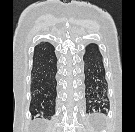 Alpha-1-antitrypsin deficiency (Radiopaedia 72058-82557 Coronal lung window 90).jpg