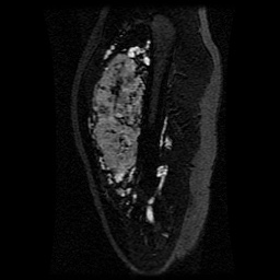 Alveolar soft part sarcoma (Radiopaedia 64501-73678 D 95).jpg