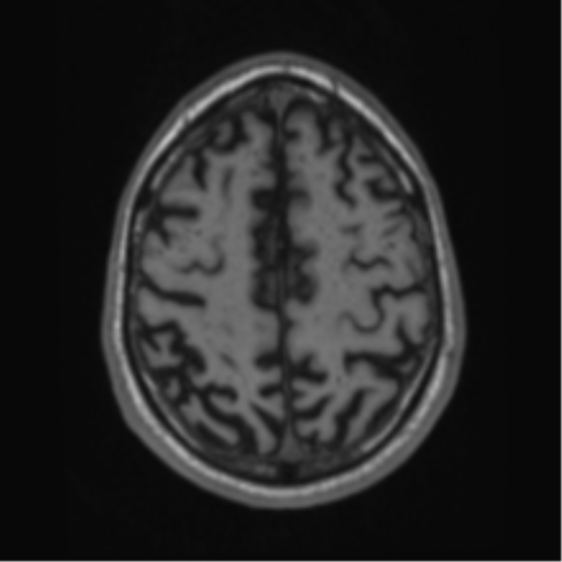 Alzheimer's disease- with Gerstmann syndrome and dressing apraxia (Radiopaedia 54882-61150 Axial T1 59).png
