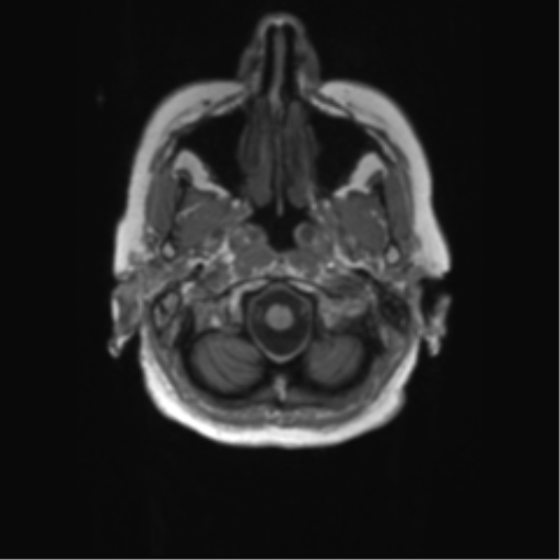 File:Alzheimer's disease (Radiopaedia 42658-45802 Axial T1 138).png